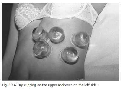 The Art of Cupping
