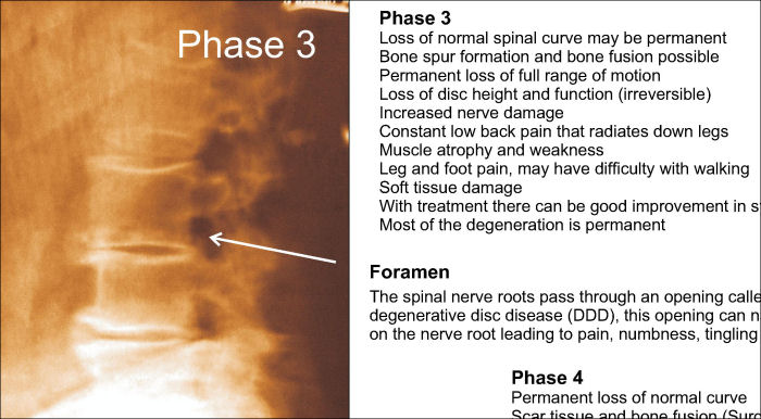 Phases Spinal Degeneration Poster