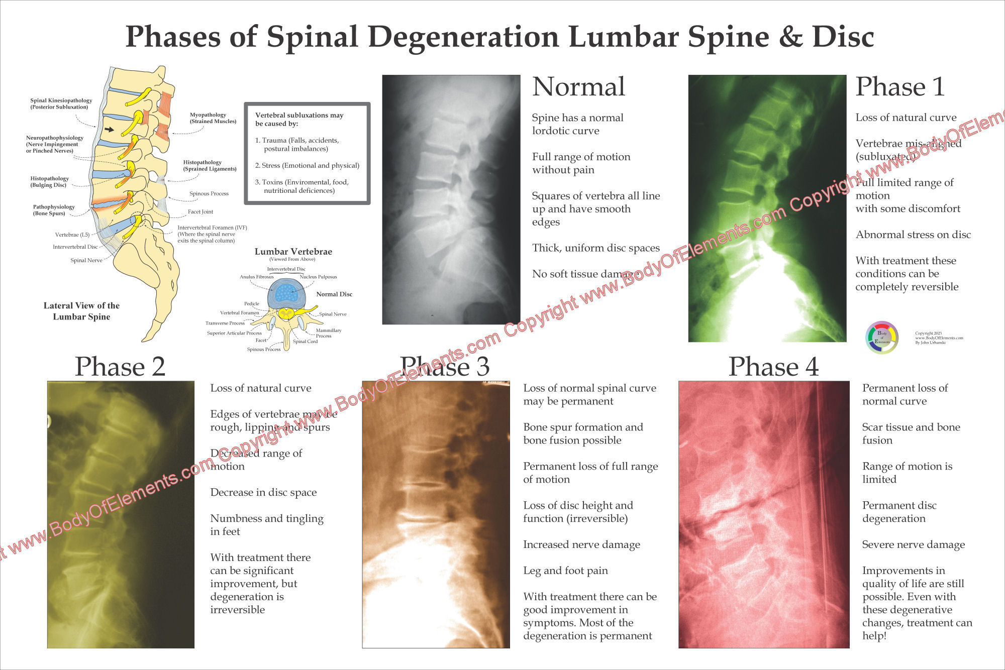 Phases of Spinal Degeneration Poster 24 x 36