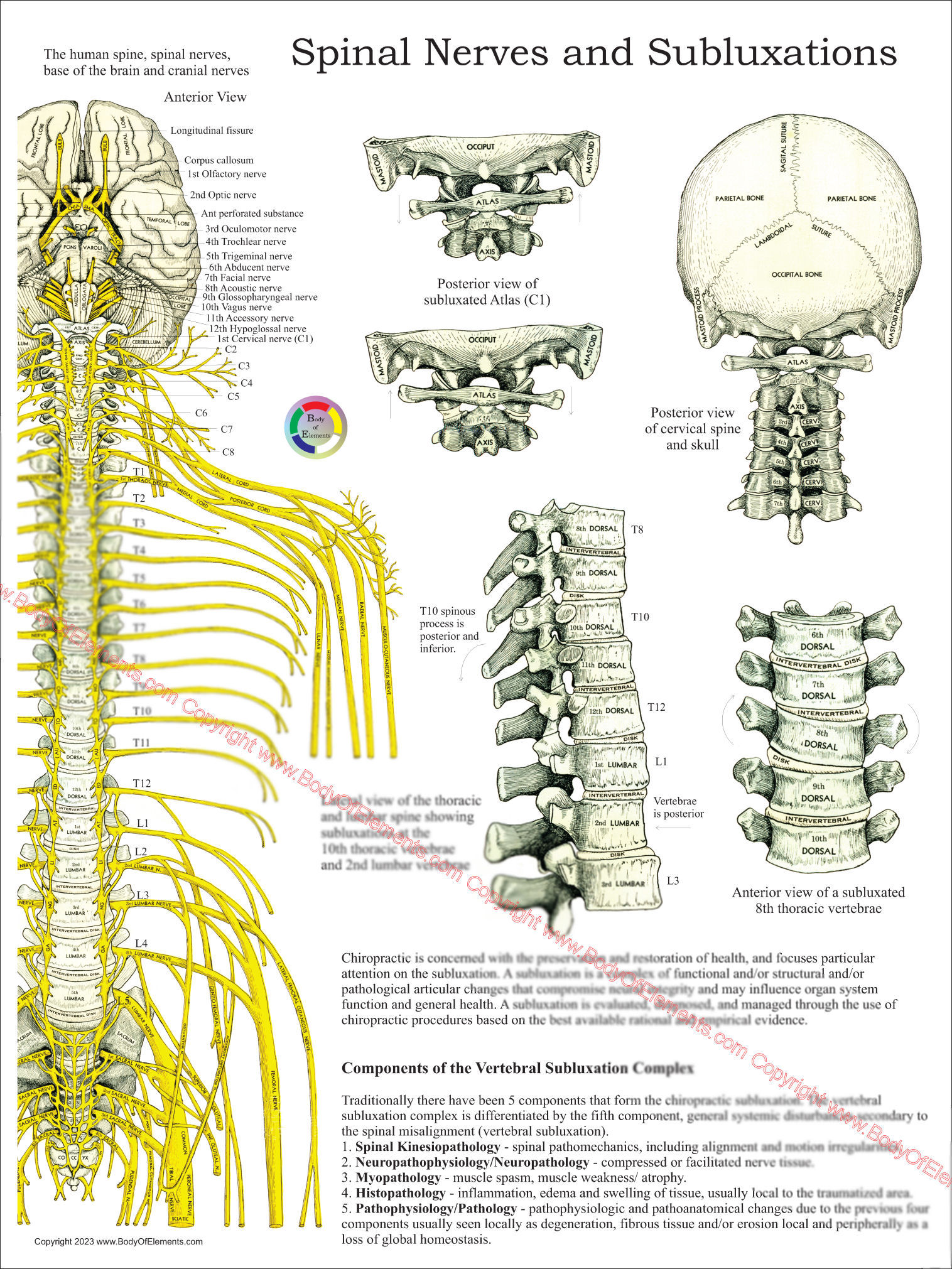 Chiropractic Subluxation Complex Poster